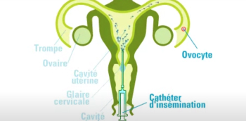 schéma d'un utérus avec un cathéter d'insémination